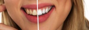 Valplast denture