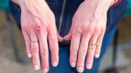 home remedies for cracked hands - hands