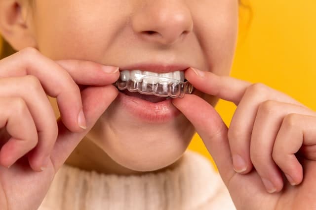 Process of getting veneers