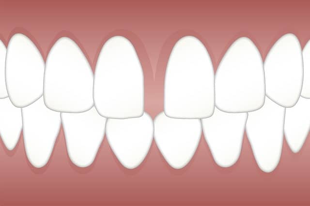 Front tooth replacement options
