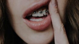 Types of Dental Braces