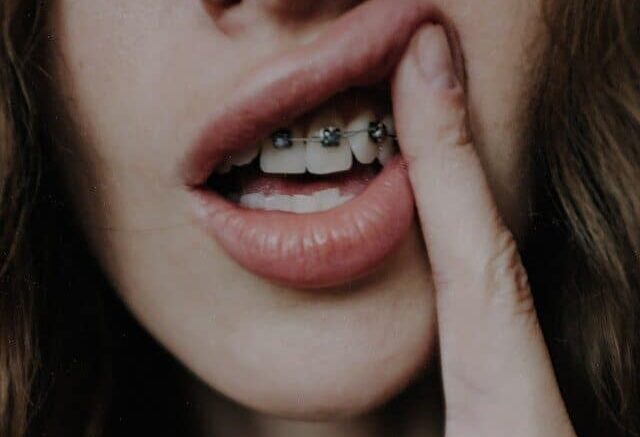 Types of Dental Braces