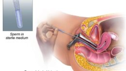 What is intrauterine insemination