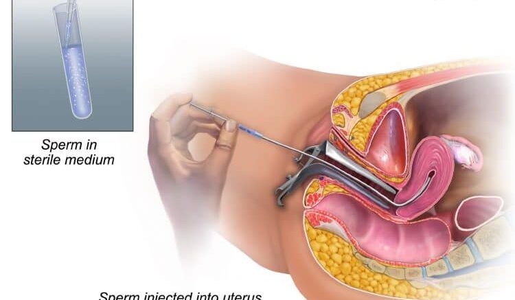What is intrauterine insemination