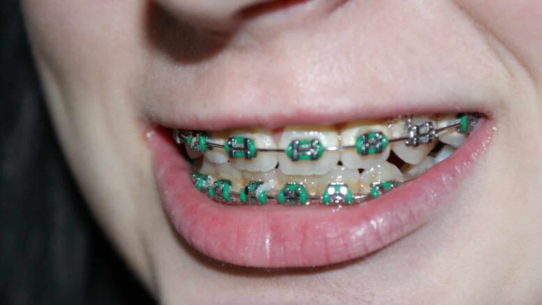 How Much do Braces Cost Without Insurance?
