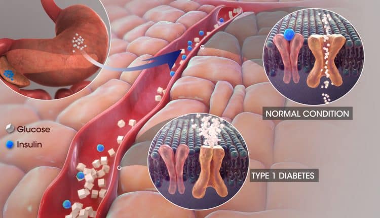Type 1 Diabetes Mellitus - What is Type 1DM